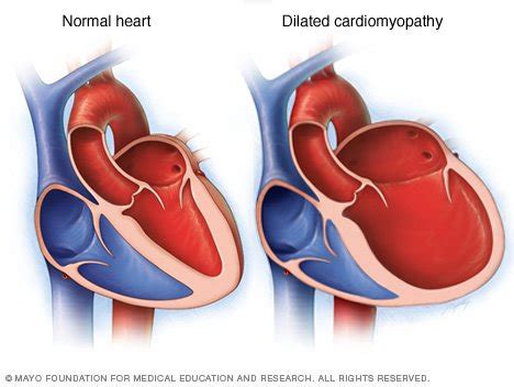 left ventricle is severely dilated